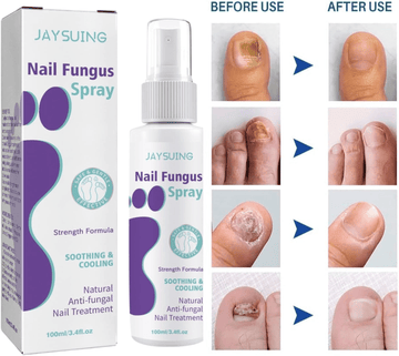 Extra Strong Nail Fungus Treatment Spray - 100ml